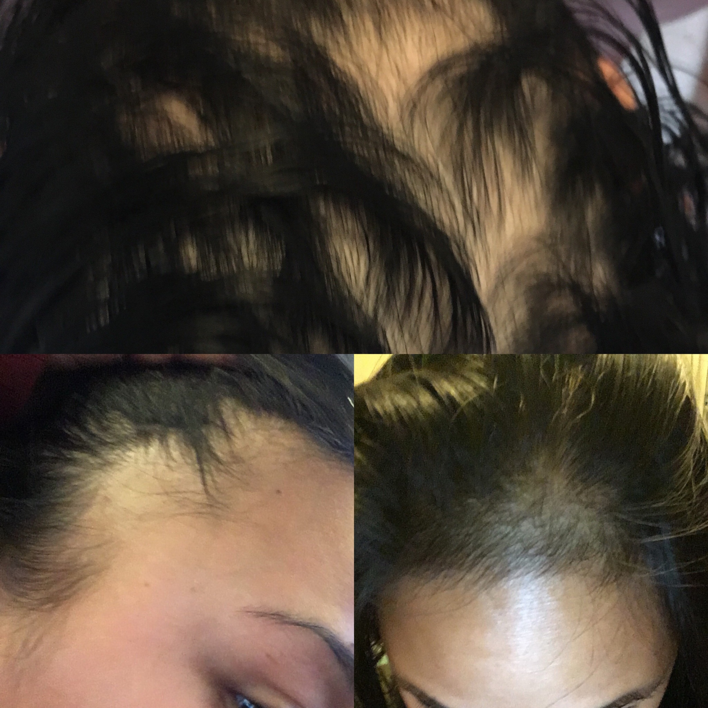 Diana Bejasa shares her personal journey with alopecia areata, an autoimmune disease that caused hair loss and fueled her mission to help leaders prevent burnout.